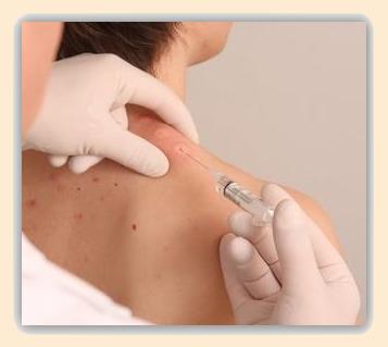 Neuraltherapie, Quaddeltechnik Neuraltherapie, Quaddeltechnik