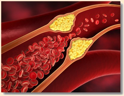 Gefäßdarstellung, Chelattherapie