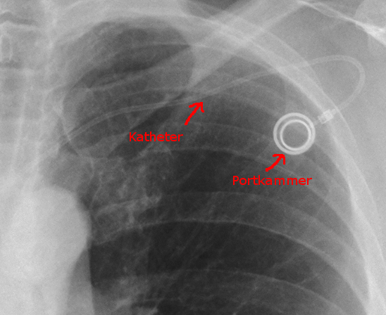 Röntgenbild Portkathether
